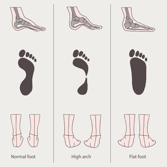 A Simple Overview of What Causes Flat Foot