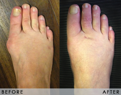 Photo Gallery, Foot & Ankle Surgery