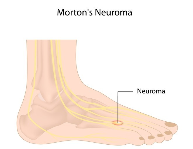 Mortons Neuroma Foot Neuroma Treatment And Surgery Extend